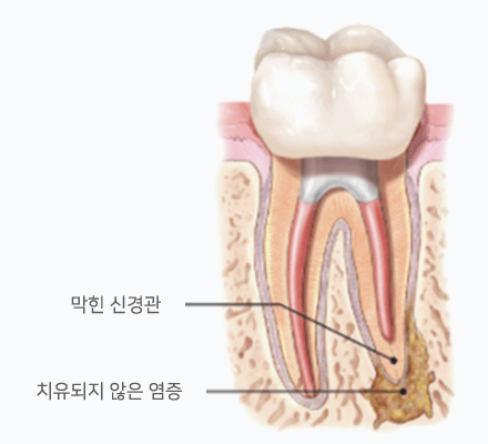 재신경치료