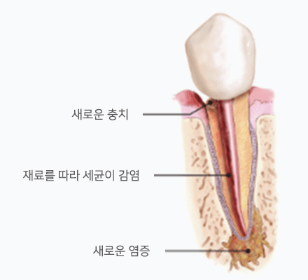 재신경치료